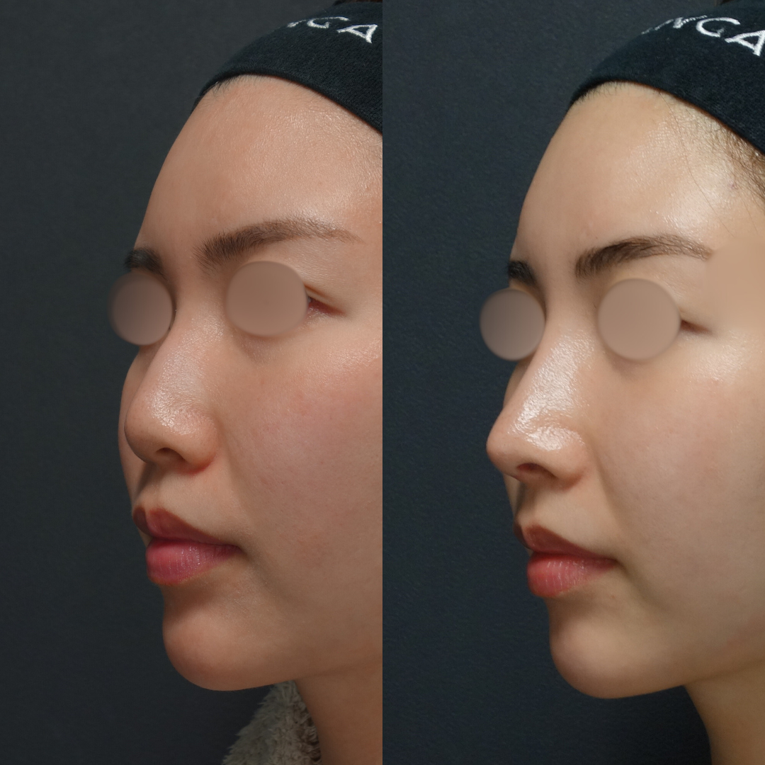 隆鼻術・鼻中隔延長術（軟骨）・砕片軟骨による貴族手術